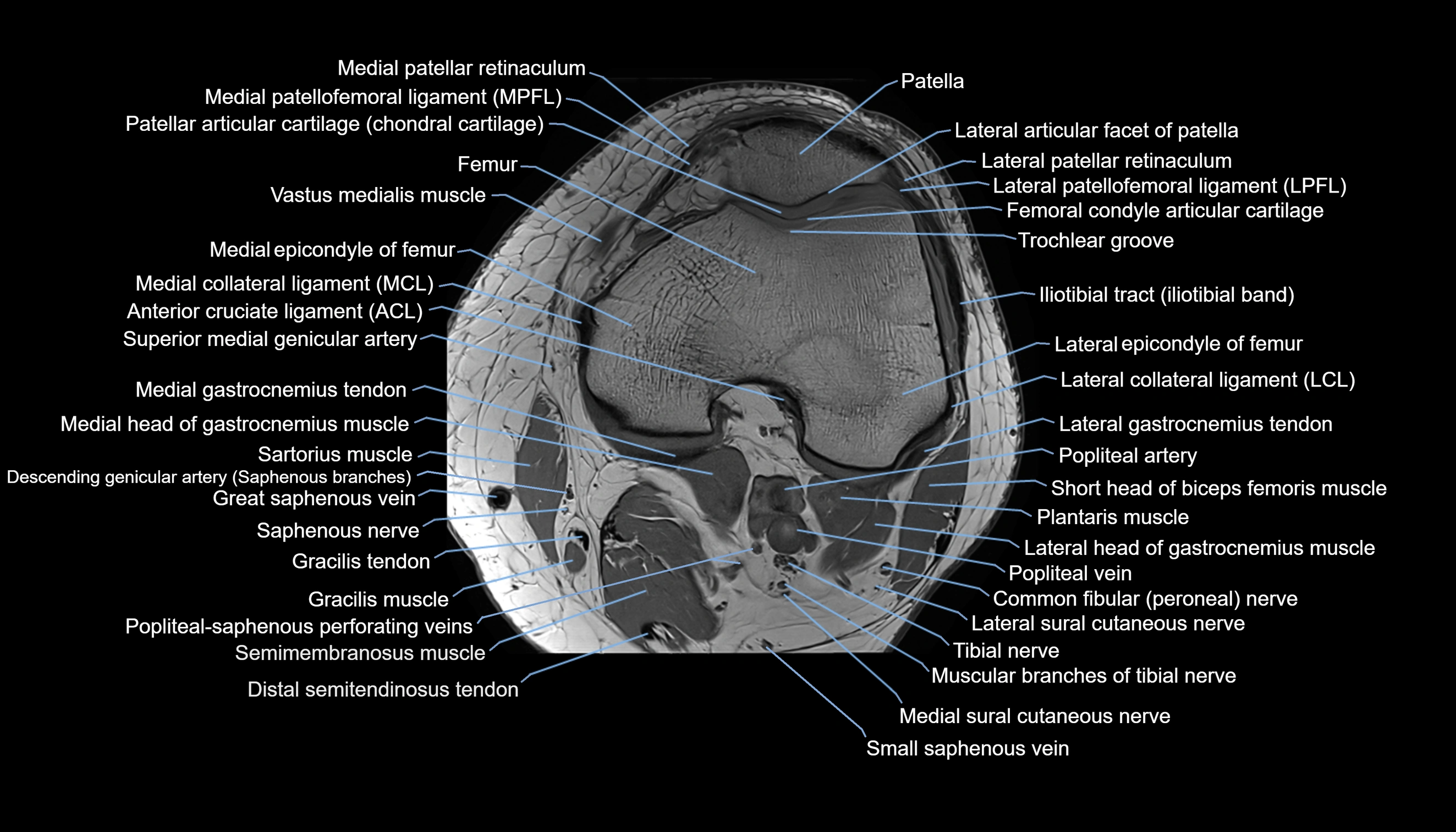 MRI knee  axial cross sectional anatomy 3T radiology  image-img-00001-00018.webp